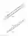 Fig. 02 - Apparatus and methods for treating hardened vascular lesions