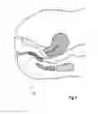 Fig. 09 - Morpho-Anatomic Flexible Web