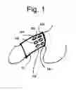 Fig. 02 - Systems and methods for the treatment of pelvic disorders including magnetic particulates