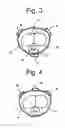 Fig. 04 - Systems and methods for the treatment of pelvic disorders including magnetic particulates