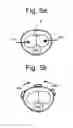 Fig. 05 - Systems and methods for the treatment of pelvic disorders including magnetic particulates