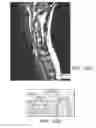 Fig. 09 - EPIDURAL STIMULATION FOR FACILITATION OF LOCOMOTION, POSTURE, VOLUNTARY MOVEMENT, AND RECOVERY OF AUTONOMIC, SEXUAL, VASOMOTOR, AND COGNITIVE FUNCTION AFTER NEUROLOGICAL INJURY