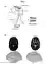 Fig. 02 - Methods and Systems for Treating Neurological Movement Disorders