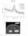 Fig. 19 - Methods and Systems for Treating Neurological Movement Disorders