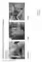 Fig. 04 - Systems and methods for growing a biofilm of probiotic bacteria on solid particles for colonization of bacteria in the gut