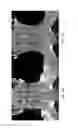 Fig. 06 - Device for Reducing Magnetic Susceptibility Artifact