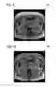 Fig. 09 - Removal of image artifacts in sense-MRI