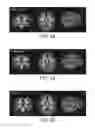 Fig. 04 - Nutritional composition and infant formula for promoting de novo myelination