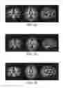 Fig. 05 - Nutritional composition and infant formula for promoting de novo myelination