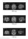 Fig. 06 - Nutritional composition and infant formula for promoting de novo myelination