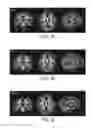 Fig. 07 - Nutritional composition and infant formula for promoting de novo myelination