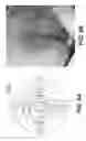 Fig. 13 - APPARATUS AND METHODS FOR DETERMINING DAMAGED TISSUE USING SUB-EPIDERMAL MOISTURE MEASUREMENTS