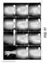 Fig. 15 - APPARATUS AND METHODS FOR DETERMINING DAMAGED TISSUE USING SUB-EPIDERMAL MOISTURE MEASUREMENTS
