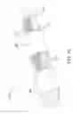 Fig. 12 - System and method for measuring an amount of blood and/or clotting in a pocket surrounding an implantable medical device