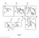 Fig. 07 - Revascularisation localisation and pre and post quantitative coronary angiography