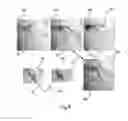 Fig. 08 - Revascularisation localisation and pre and post quantitative coronary angiography