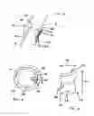 Fig. 02 - Positionable perivalvular occlusion device