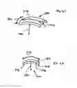 Fig. 23 - Positionable perivalvular occlusion device