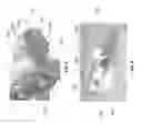 Fig. 06 - Patient-specific bridging plates