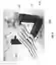 Fig. 08 - Patient-specific bridging plates