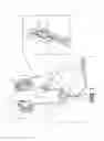 Fig. 02 - Kidney stone suction device
