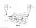 Fig. 04 - Systems and methods for separating tissue in corneal transplant procedures