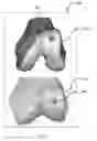 Fig. 04 - SYSTEM AND METHOD FOR CREATING A DECISION SUPPORT MATERIAL INDICATING DAMAGE TO AN ANATOMICAL JOINT