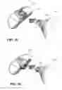 Fig. 25 - METHOD AND DEVICE FOR INCREASING BONE DENSITY IN THE MOUTH