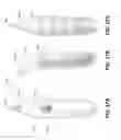 Fig. 33 - METHOD AND DEVICE FOR INCREASING BONE DENSITY IN THE MOUTH