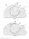 Fig. 06 - METHOD OF ASSEMBLING A DISTALIZER