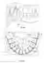 Fig. 09 - Method and apparatus for restoring improper morphology of the alveolar bone