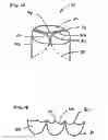 Fig. 02 - Free edge supported mitral valve