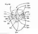 Fig. 07 - Free edge supported mitral valve