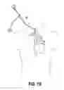 Fig. 09 - Vascular device for treating venous valve insufficiency