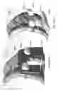 Fig. 149 - Patient-Adapted and Improved Articular Implants, Designs and Related Guide Tools