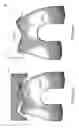 Fig. 152 - Patient-Adapted and Improved Articular Implants, Designs and Related Guide Tools