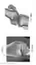 Fig. 241 - Patient-Adapted and Improved Articular Implants, Designs and Related Guide Tools