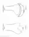 Fig. 43 - Patient-Adapted and Improved Articular Implants, Designs and Related Guide Tools