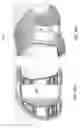 Fig. 69 - Patient-Adapted and Improved Articular Implants, Designs and Related Guide Tools