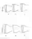Fig. 98 - Patient-Adapted and Improved Articular Implants, Designs and Related Guide Tools