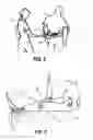 Fig. 03 - Gait belt
