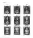 Fig. 15 - Method of Treatment of Alopecia with Monoterpenoids