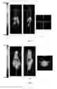 Fig. 04 - Neutron capture therapy system for eliminating amyloid β-protein