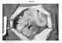 Fig. 06 - Patch graft compositions for cell engraftment