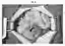 Fig. 06 - PATCH GRAFT COMPOSITIONS FOR CELL ENGRAFTMENT