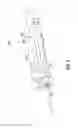 Fig. 03 - POWER ASSISTED LIPOPLASTY