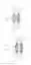 Fig. 10 - Systems and methods for creating permanent drainage fistula