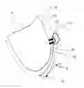 Fig. 01 - Steerable epicardial pacing catheter system placed via the subxiphoid process