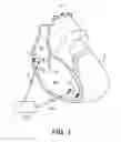Fig. 02 - Pacing mode switching in a ventricular pacemaker
