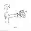 Fig. 02 - Removable middle ear implant sensor